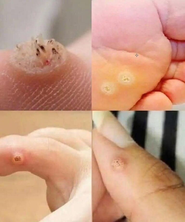 Apple Cider Vinegar for Warts: Can This Natural Remedy Really Help?