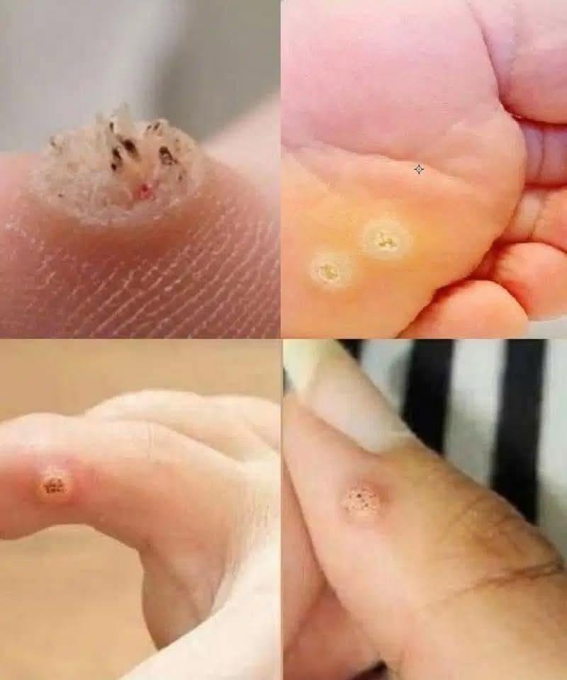 Apple Cider Vinegar for Warts: Can This Natural Remedy Really Help?