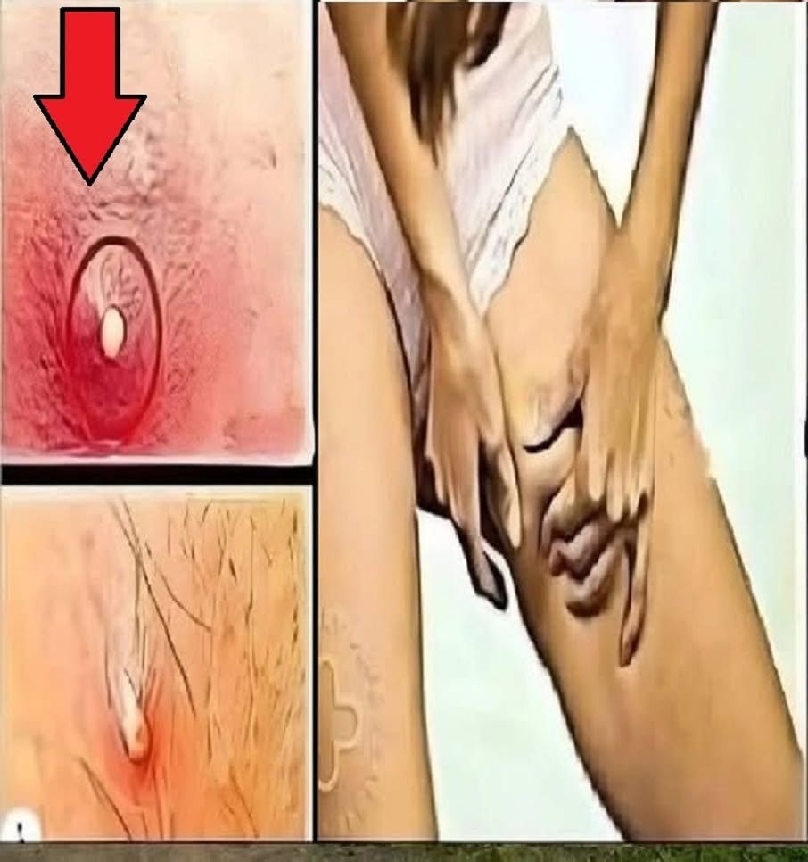 Groin Skin Irritation: Common Causes, Symptoms, Treatment, and Prevention Tips