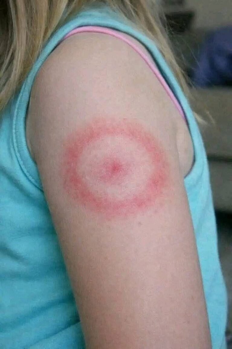 A Red Ring on Your Child’s Skin? Here’s What Parents Should Know