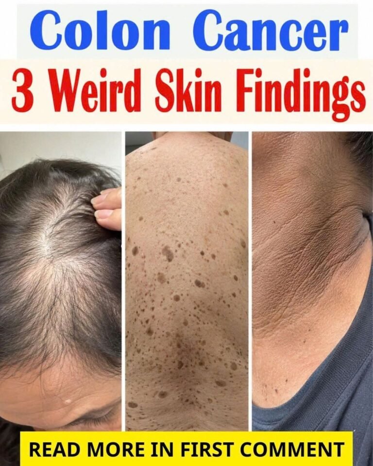 Colon Cancer Signs on the Skin: 3 Warning Changes You Shouldn't Ignore