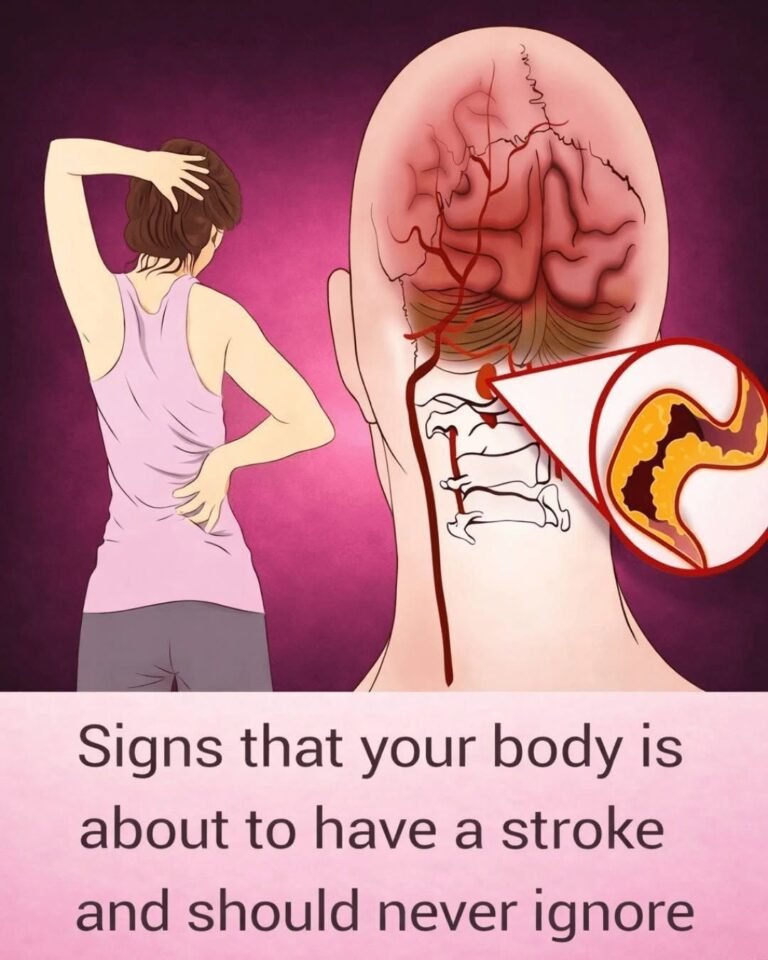 10 Early Warning Signs of a Stroke Everyone Should Know