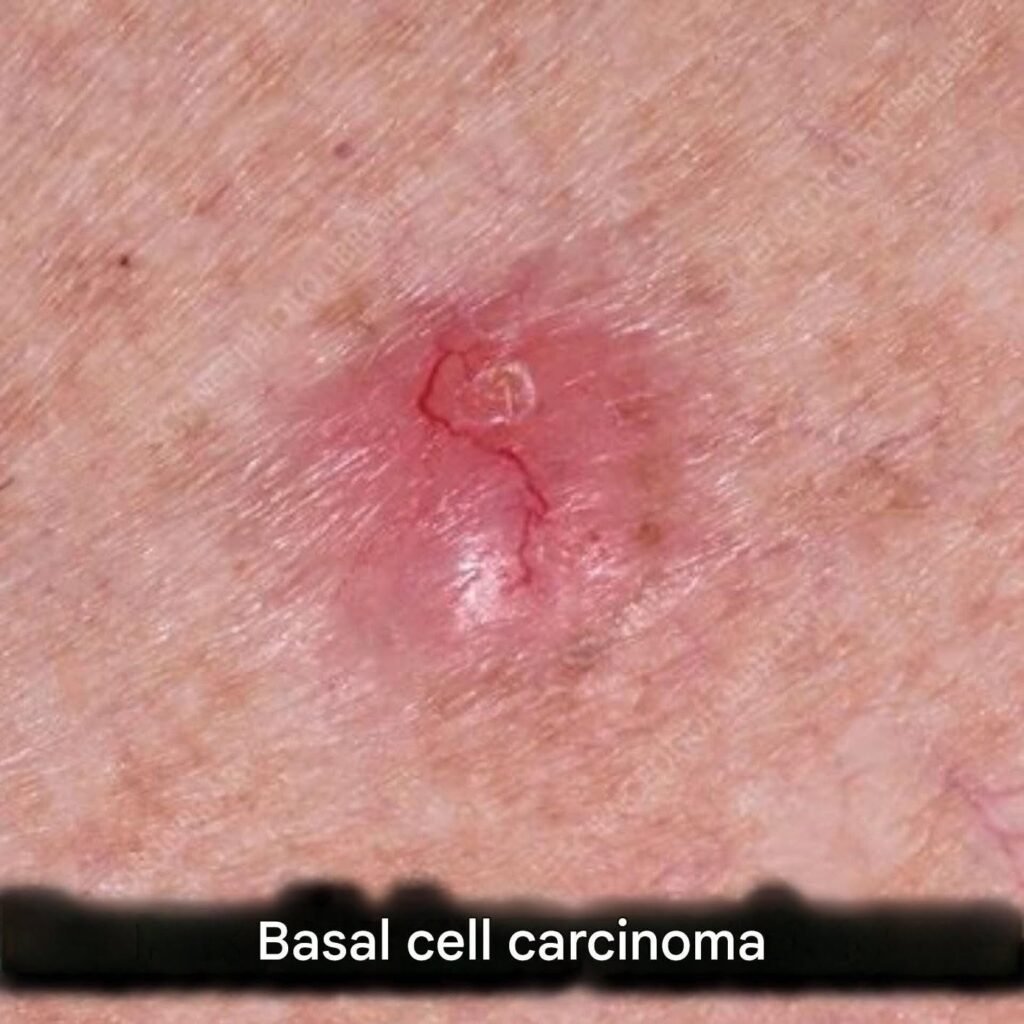 Basal Cell Carcinoma Symptoms: Early Signs, Causes, Diagnosis & Treatment