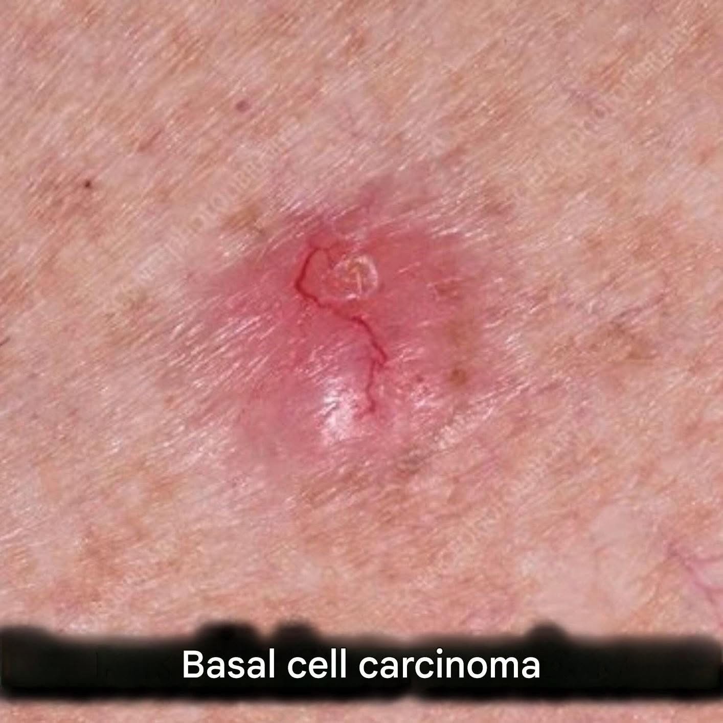 Basal Cell Carcinoma Symptoms: Early Signs, Causes, Diagnosis & Treatment