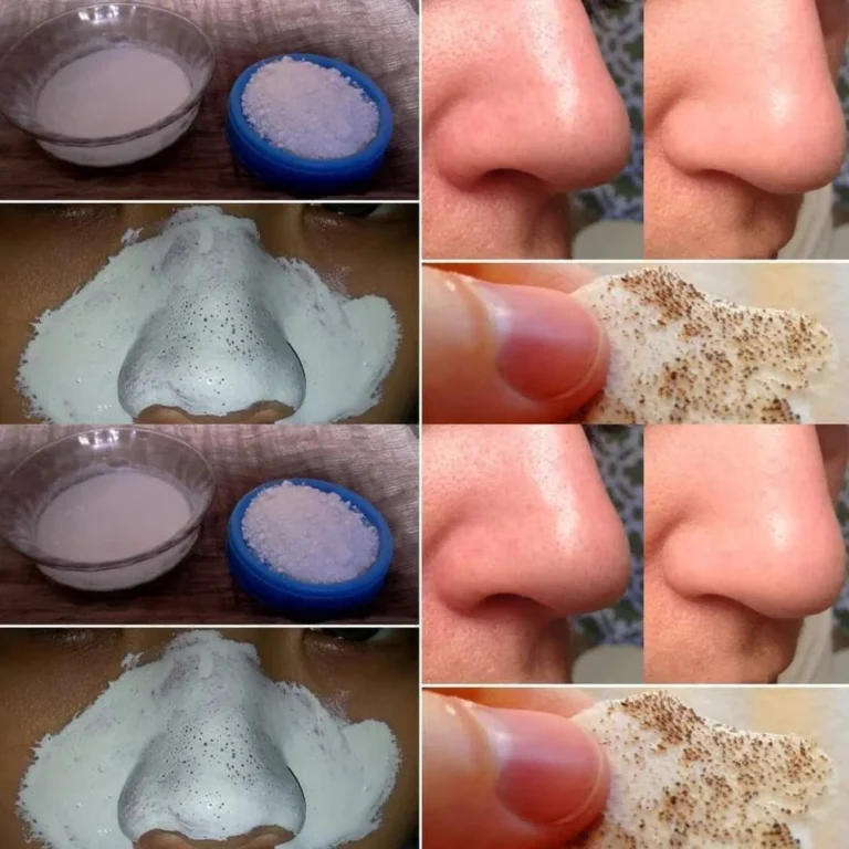 Blackheads Explained: Safe and Effective Ways to Remove Blackheads and Keep Your Skin Healthy