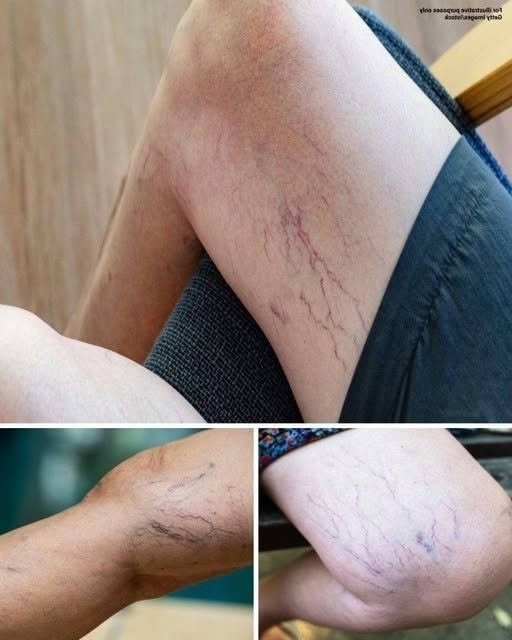 If You Have Purple Veins on Your Legs, Here's What They May Mean
