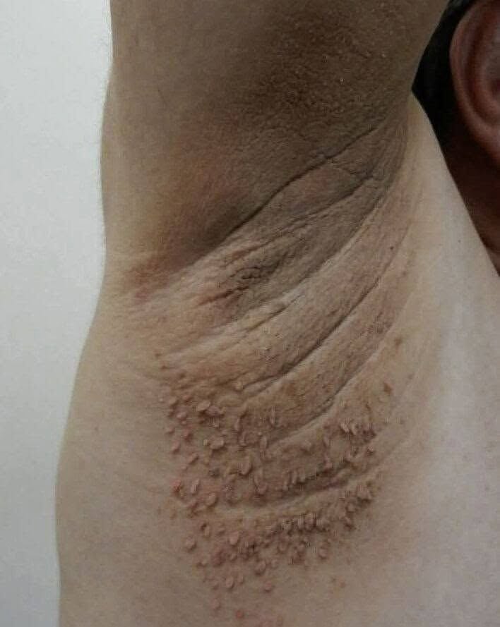 Dark Patches on the Neck: Could It Be Acanthosis Nigricans? Signs, Causes, Symptoms & Treatment