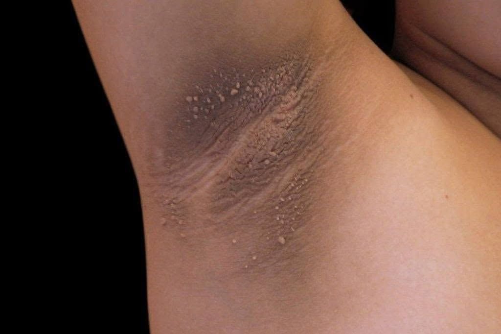 These Are the First Symptoms of Diabetes You Should Never Ignore