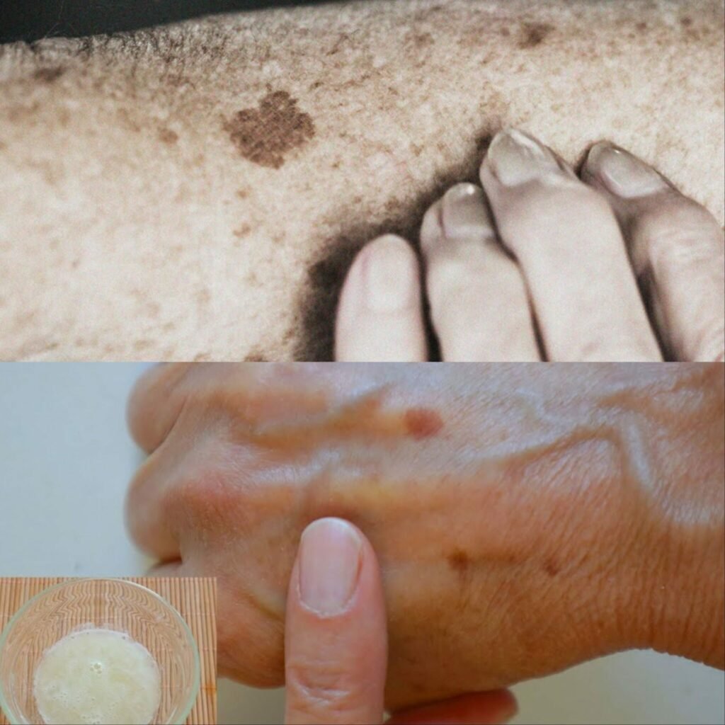 Can Baking Soda Help Remove Age Spots, Warts, and Skin Spots? Benefits, Risks & Safe Use