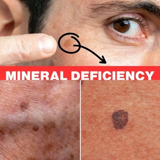 Lack of This Mineral Is Causing Your Age Spots: