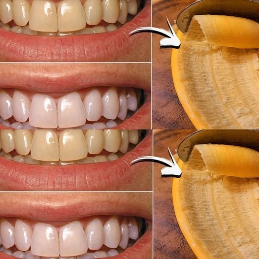 🍌 Banana Peel for Teeth: Can It Really Whiten Your Smile?