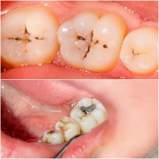 Can You Reverse a Cavity? What You Can—and Can't—Do at Home