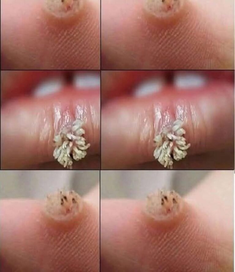 Understanding Warts: Causes, Symptoms, Treatment, and Prevention