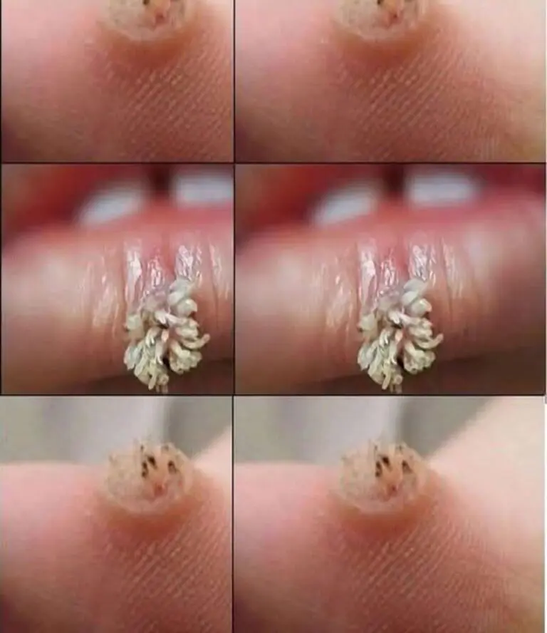 Understanding Warts: Causes, Symptoms, Treatment, and Prevention