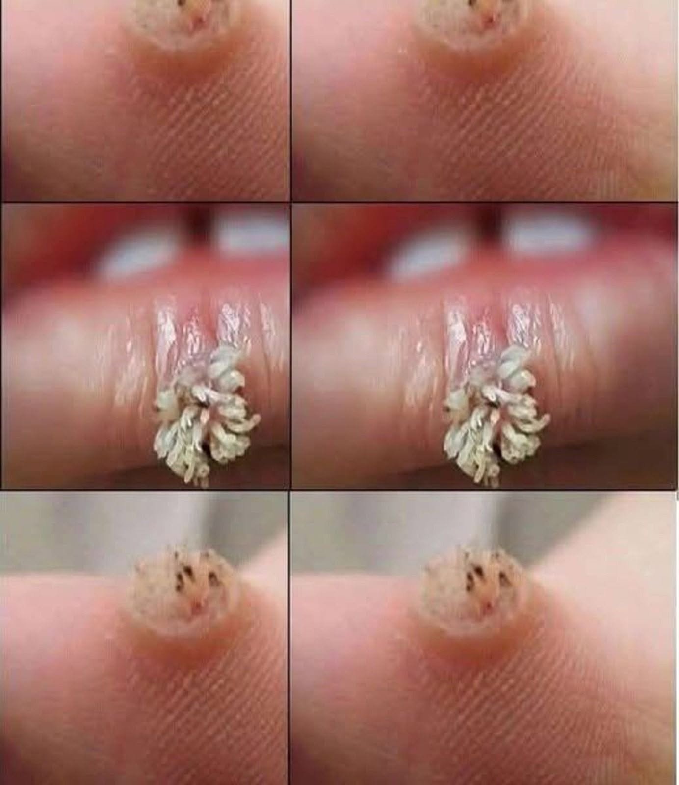 Understanding Warts: Causes, Symptoms, Treatment, and Prevention