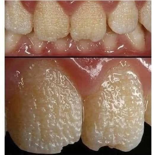 Tooth Enamel Damage: Causes of Wear, Warning Signs, and How to Protect Your Smile