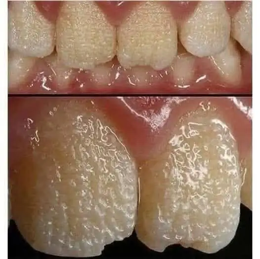Tooth Enamel Damage: Causes of Wear, Warning Signs, and How to Protect Your Smile