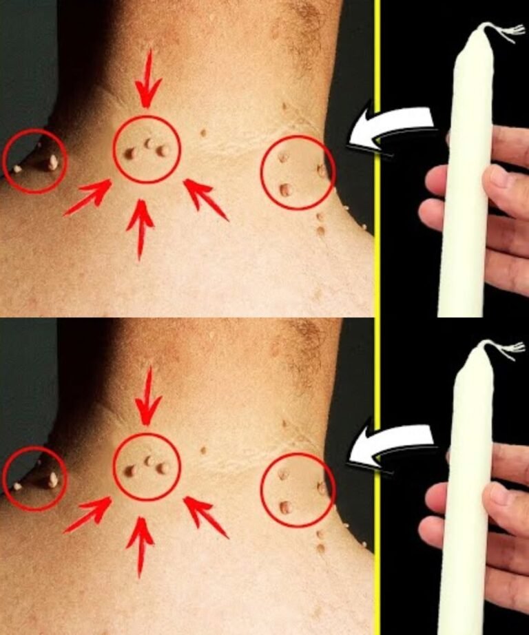 Remove Skin Tags in Just 3 Days – With Just One Candle! 🔥💯