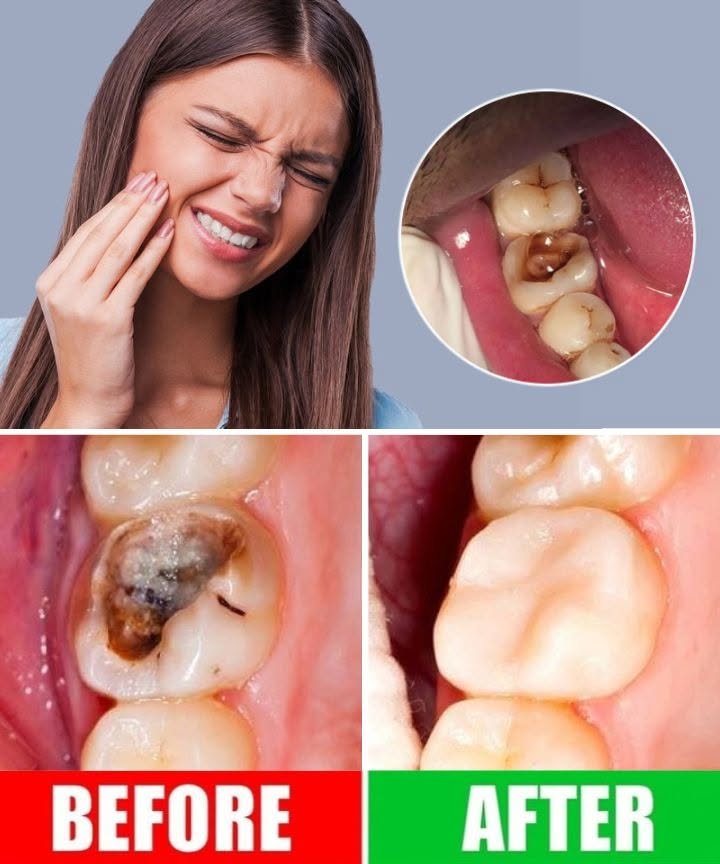 How to Naturally Prevent Cavities and Support Better Dental Health