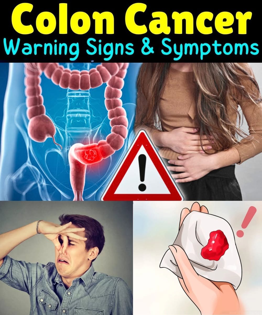 12 Silent Signs of Colon Cancer Many People Overlook
