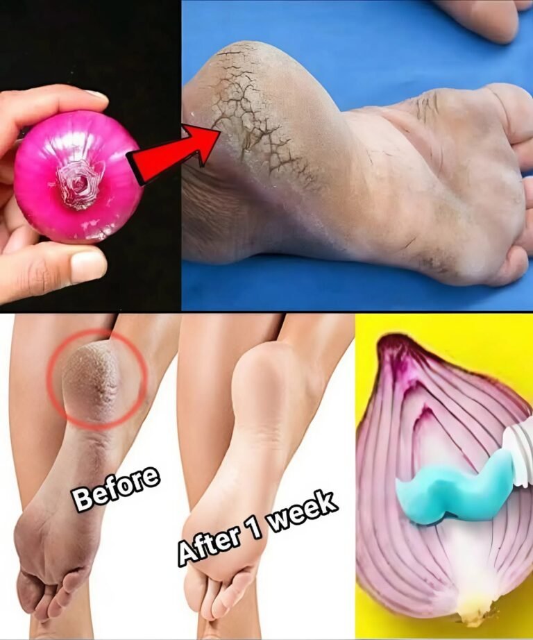 5 Proven Natural Remedies for Cracked Heels
