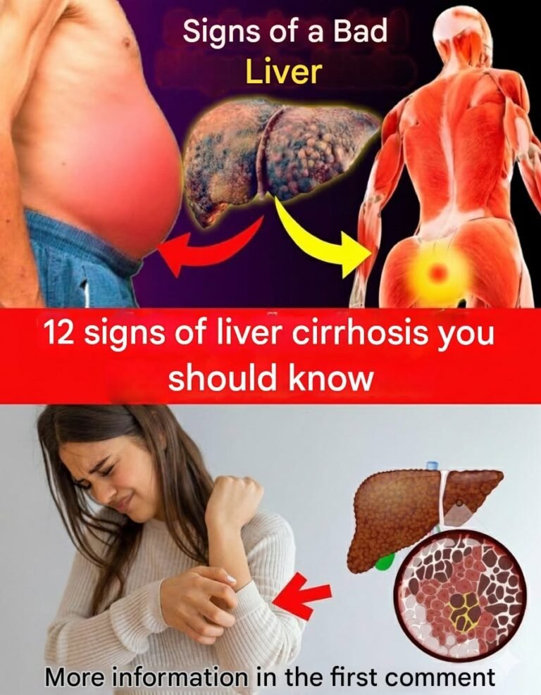 12 Warning Signs of Liver Cirrhosis You Shouldn’t Ignore