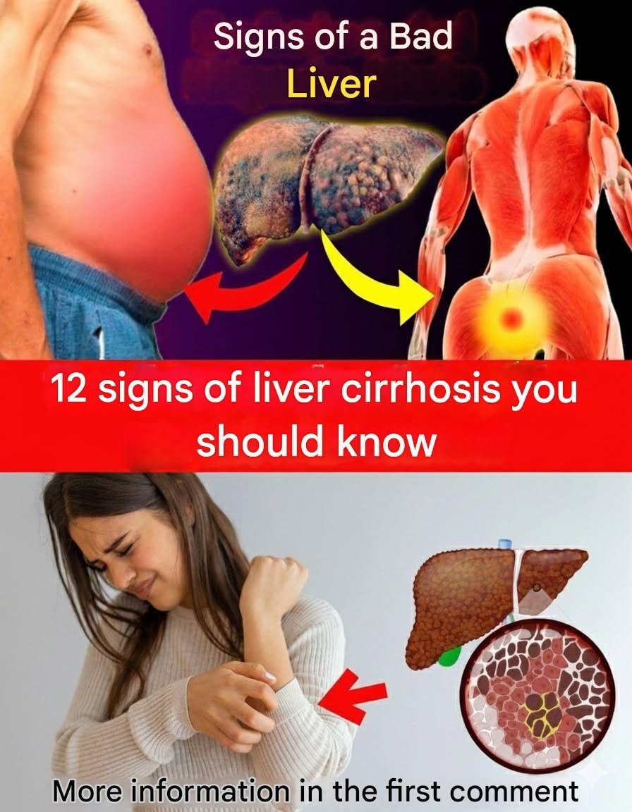 12 Warning Signs of Liver Cirrhosis You Shouldn’t Ignore