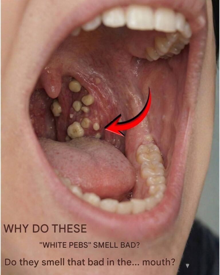 😮‍💨 What Are Those Smelly White “Stones” in the Mouth That Cause Terrible Bad Breath?