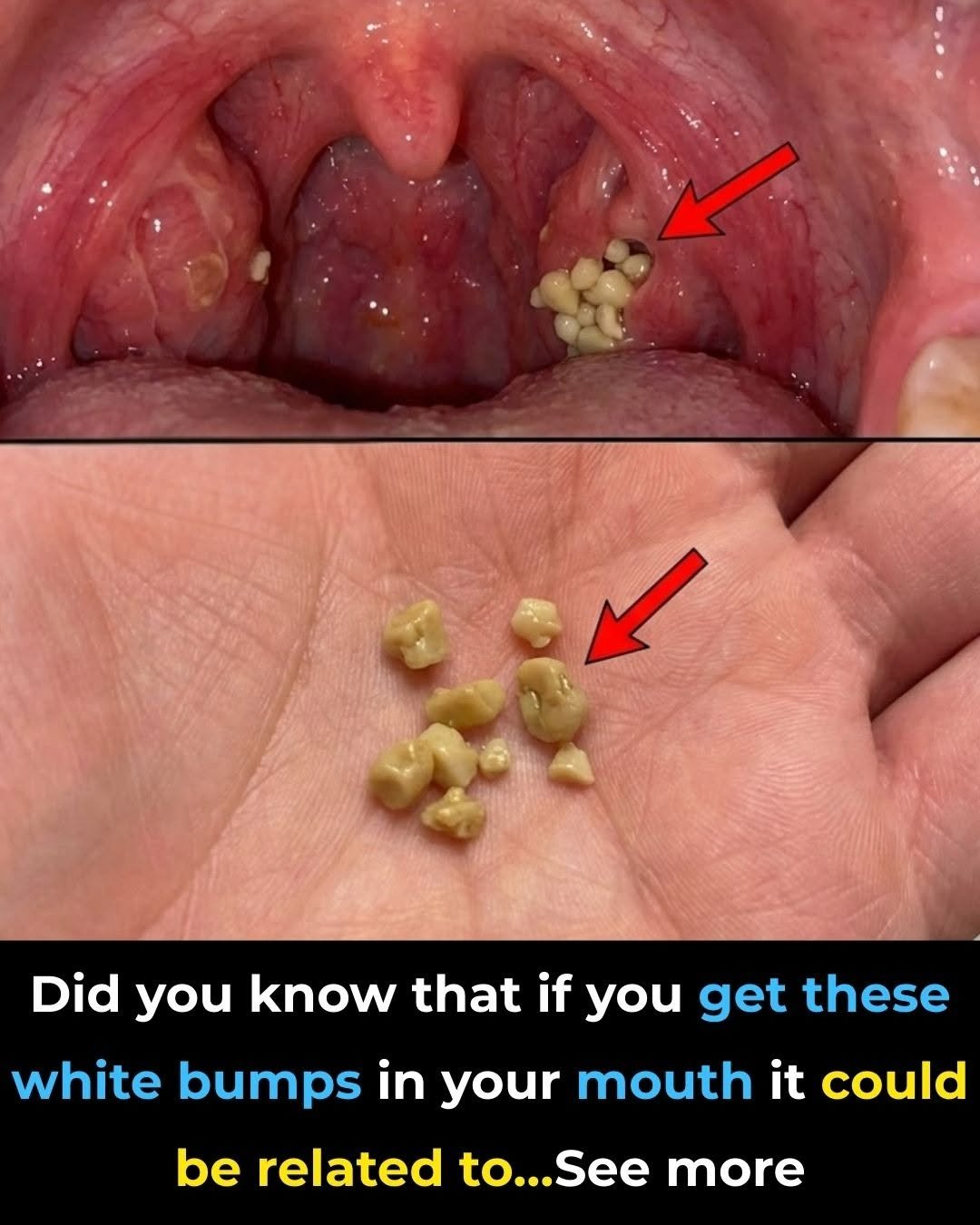 White Bumps in Your Mouth: Common Causes, Symptoms, and When to See a Doctor