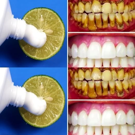 In Just 2 Minutes – Naturally Whiten Your Teeth with Toothpaste & Lemon 🍋