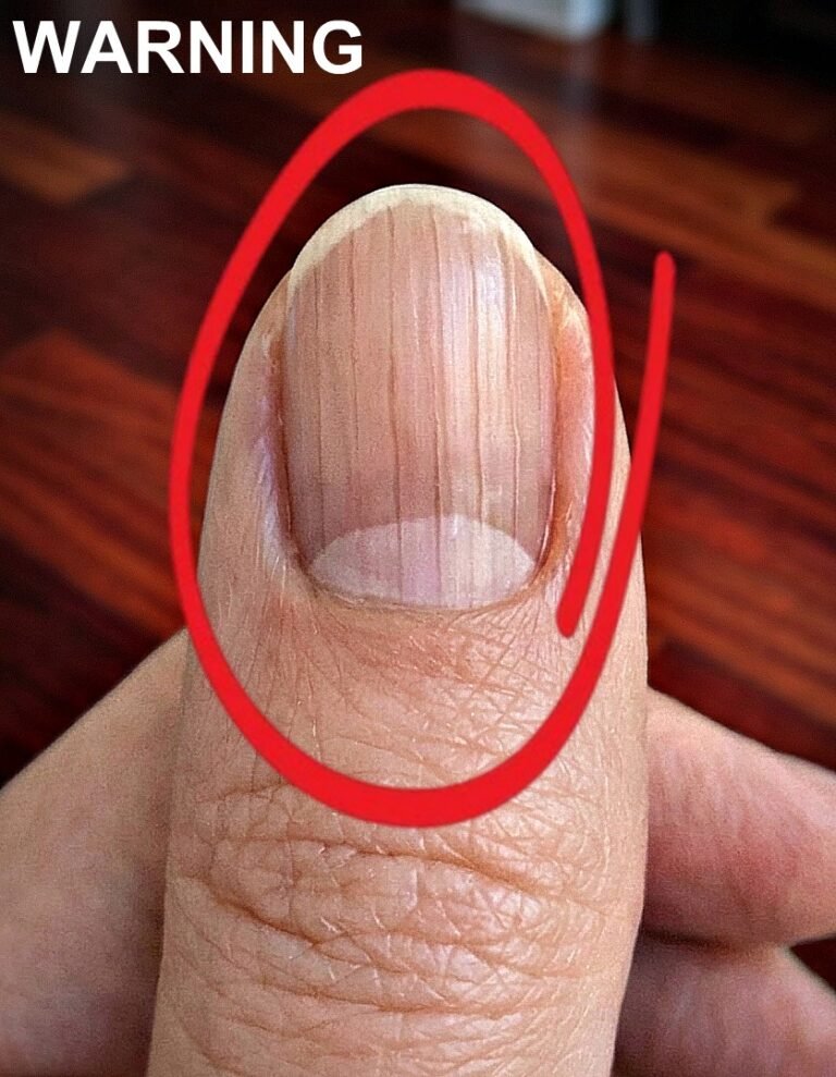 If you have lines on your nails, it means you have ca…See more