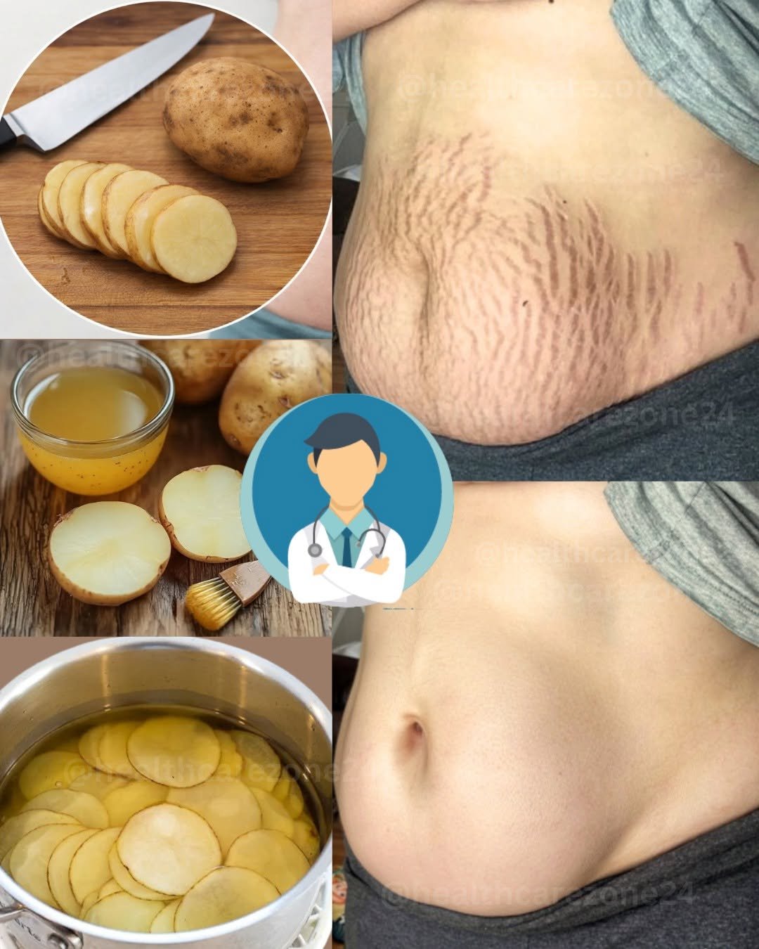 A Simple Natural Remedy to Reduce the Appearance of Stretch Marks