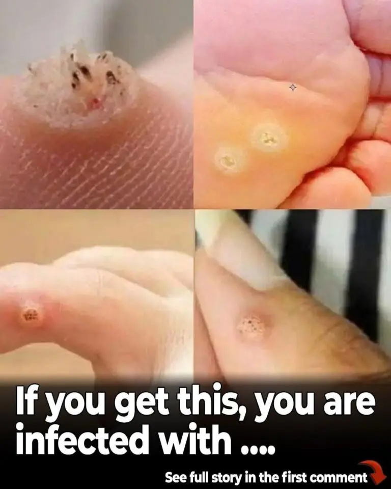 6 Common Types of Warts: Signs, Symptoms, Home Remedies, and Treatment Options