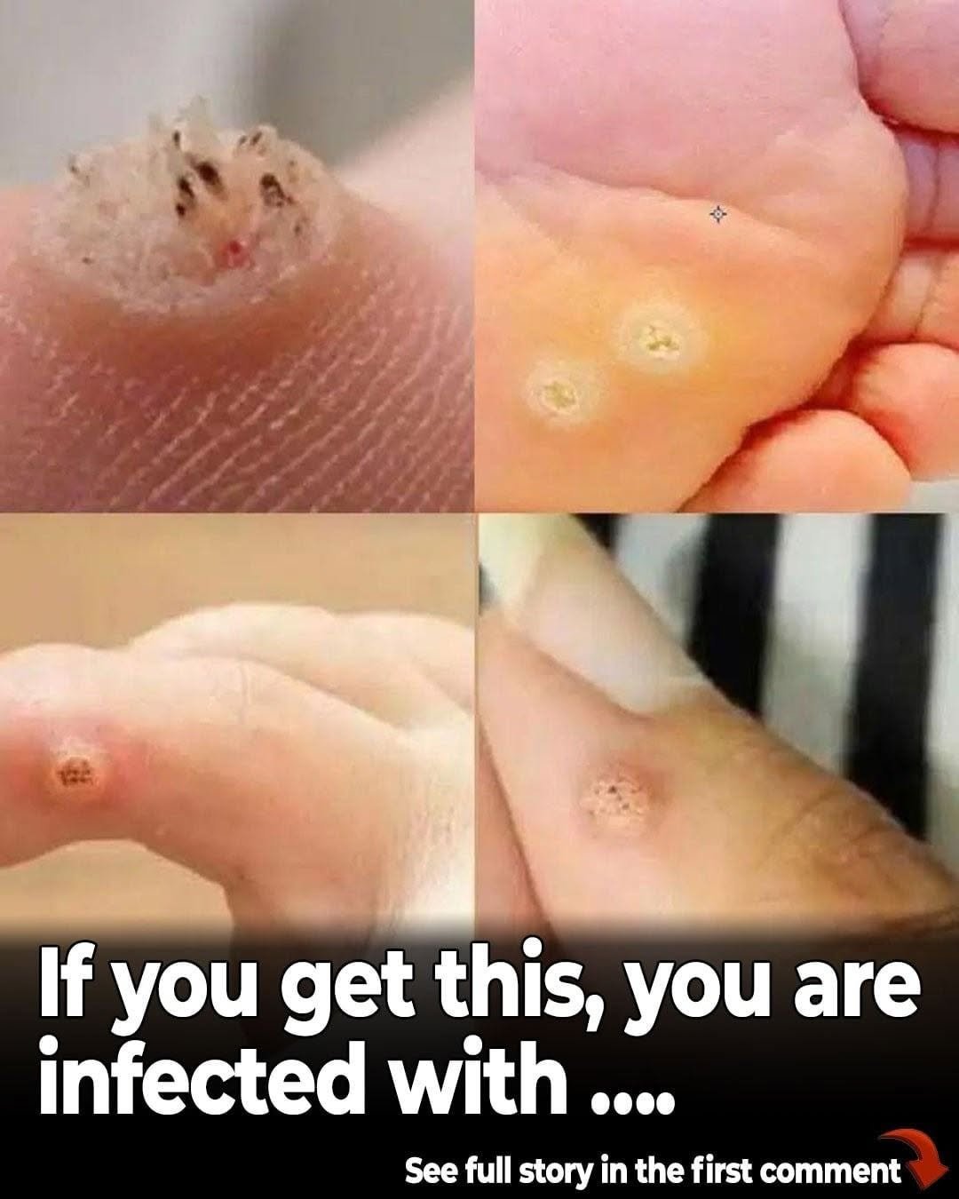6 Common Types of Warts: Signs, Symptoms, Home Remedies, and Treatment Options