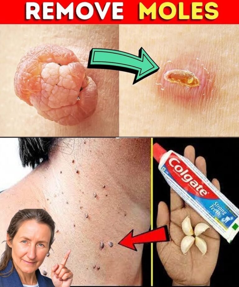 Natural Remedy for Warts & Skin Tags — Start Healing Tonight