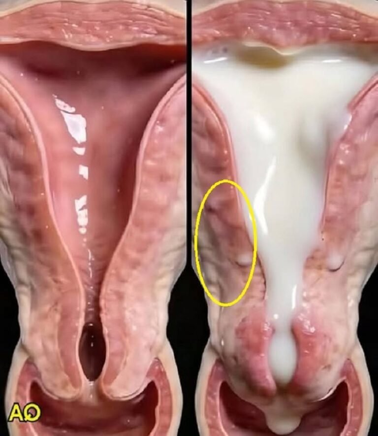 Cervical Cancer: Causes, Symptoms, Risk Factors, and Prevention