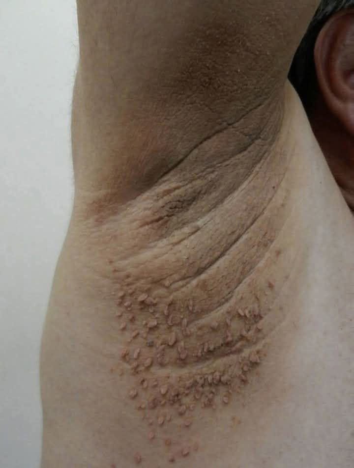 Dark Patches on the Neck: When They May Signal a Health Concern