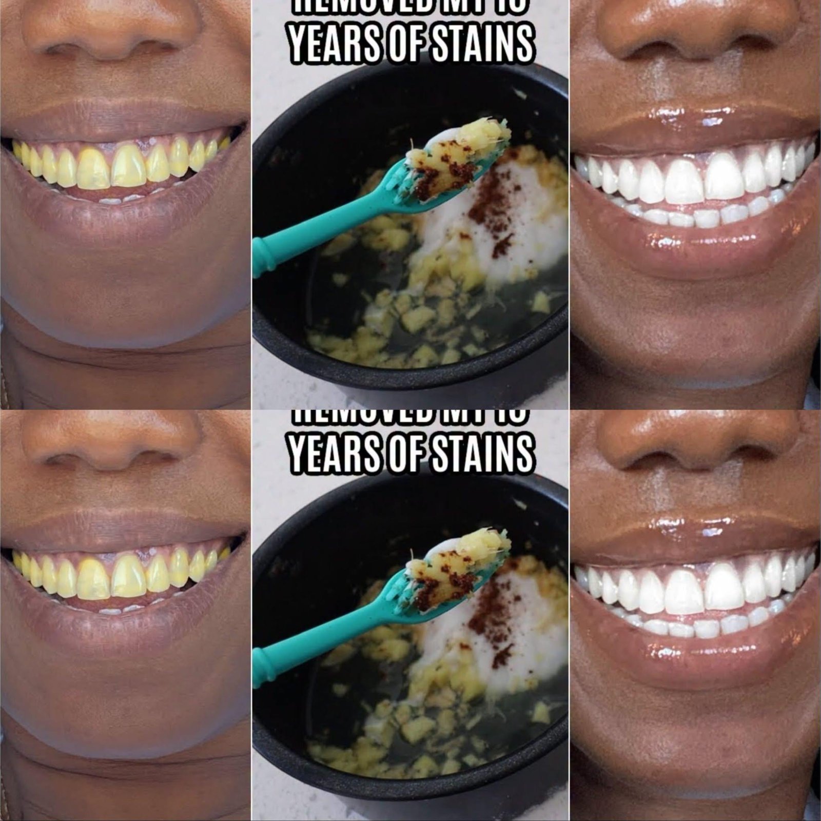 In Two Minutes Remove 10 Years of Stains from Teeth!! Results Will Shock You