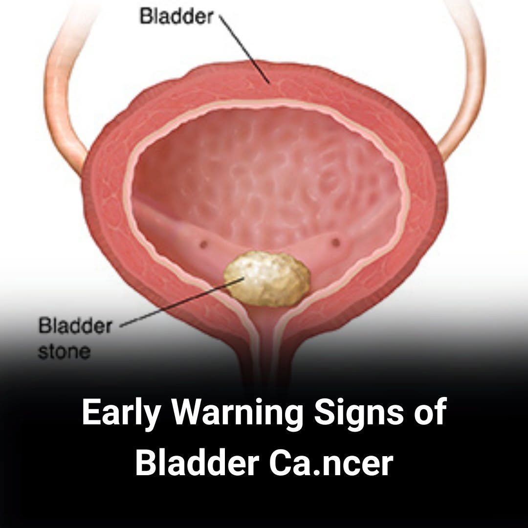 Is Your Body Sending a Signal? Early Signs of Bladder Cancer You Shouldn't Ignore