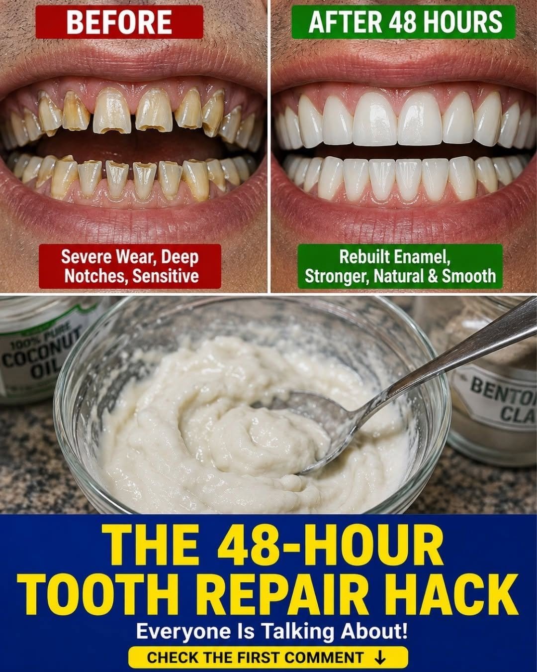 Tooth Notches at the Gumline: Causes, Sensitive Teeth Treatment, and How to Protect Your Smile