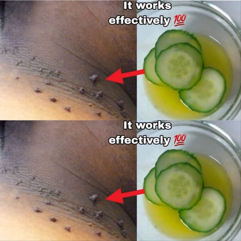 Diy skin tag removal in 3 day quickly, how to remove skin tag removal with lemon in 3 day quickly