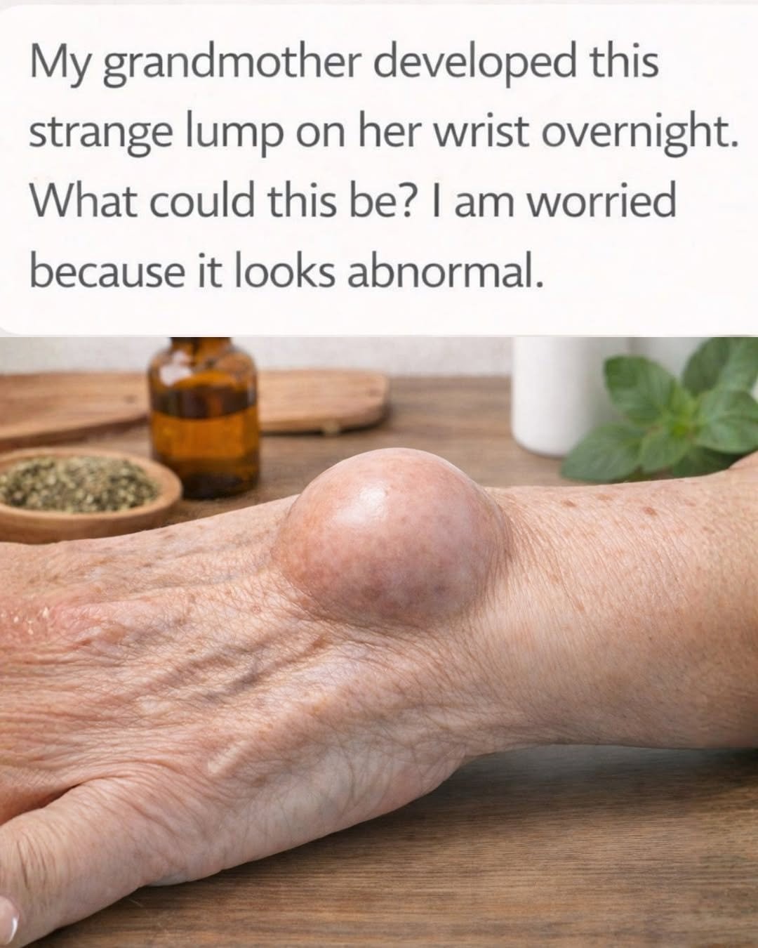 My grandmother developed this strange lump on her wrist overnight. What could this be? I am worried because it looks abnormal.