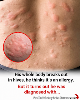 18 Possible Signs of Histamine Intolerance (And What May Be Behind Them)
