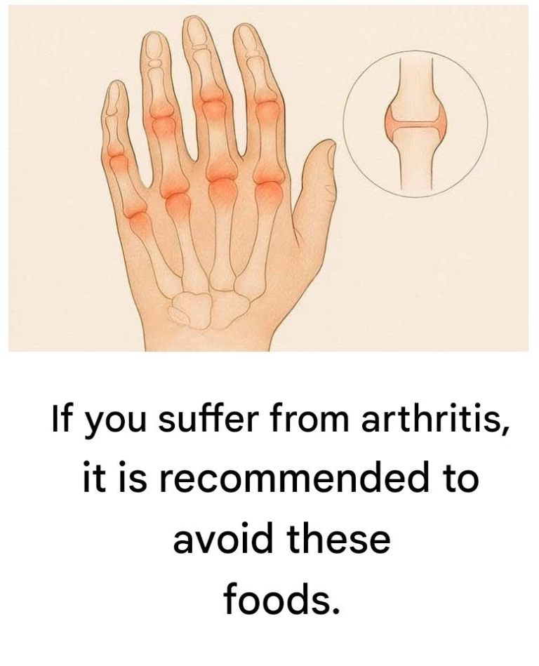 Arthritis: Foods to Limit for Better Joint Health and Less Inflammation