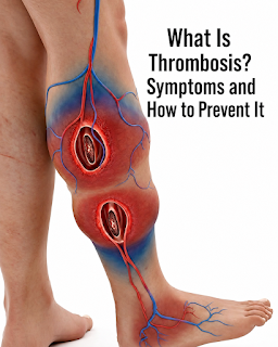 Thrombosis: Understanding the Warning Signs, Risk Factors, and Natural Ways to Support Healthy Circulation