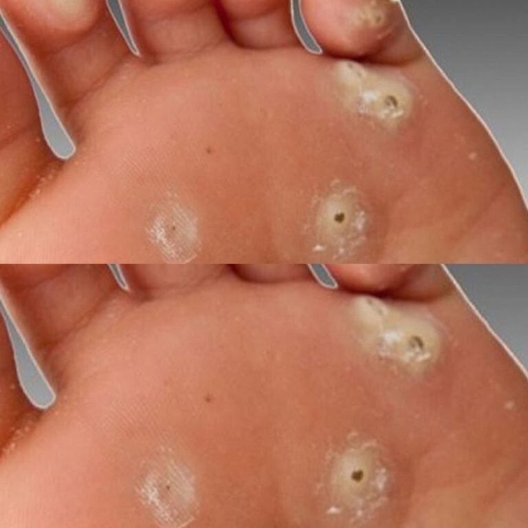 Natural Remedies for Corns – Say Goodbye to Painful Foot Corns!