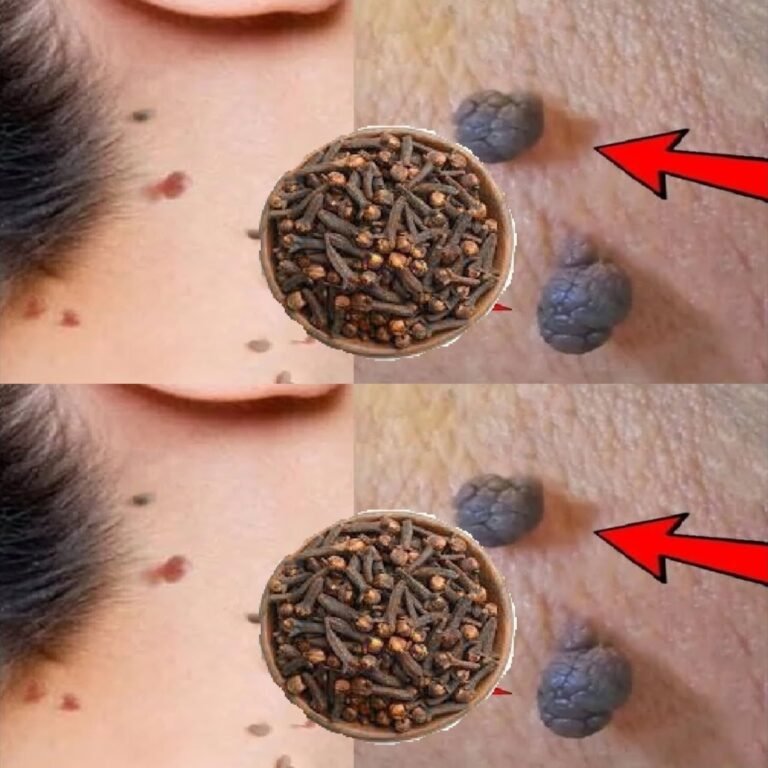 Cloves to Remove Skin Tags and Warts in One Night: A Natural Remedy