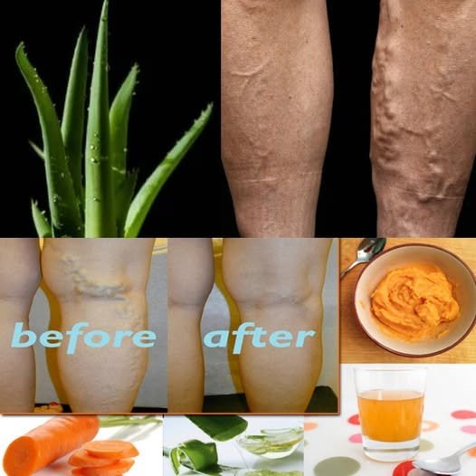 Unbelievable! Forget Varicose Veins Forever! Aloe Vera