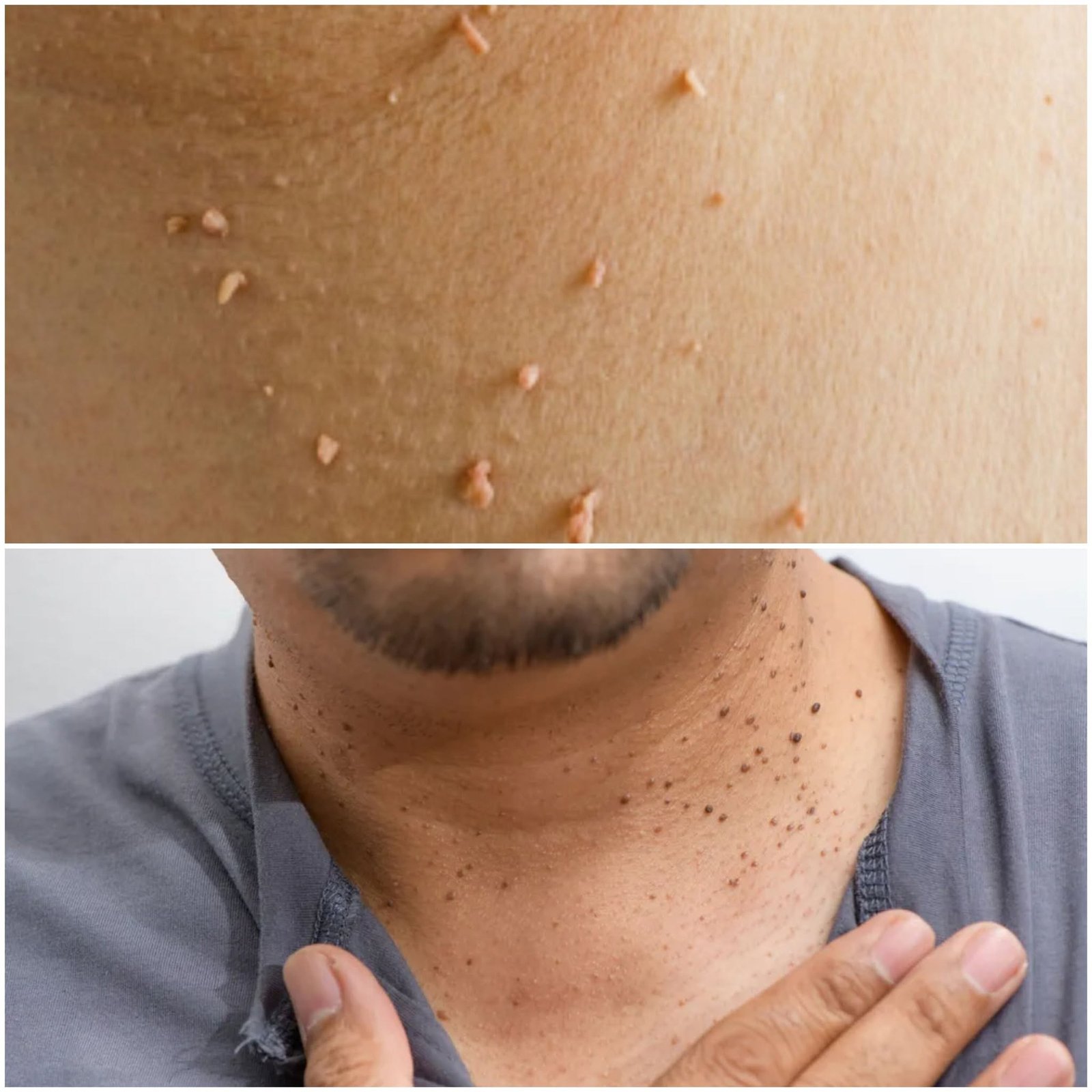 Skin Tags & Plantar Warts DISAPPEAR Overnight? [Best Natural Home Remedies]