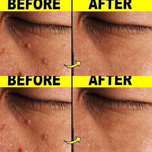 Removing Skin Tags at Home: Easy and Effective Remedies
